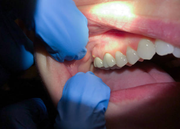 Best Emergency Dentist for Knocked-Out Tooth in Logansport, IN