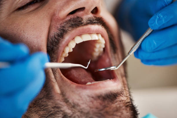 Best Emergency Root Canal Treatment in Logansport, IN